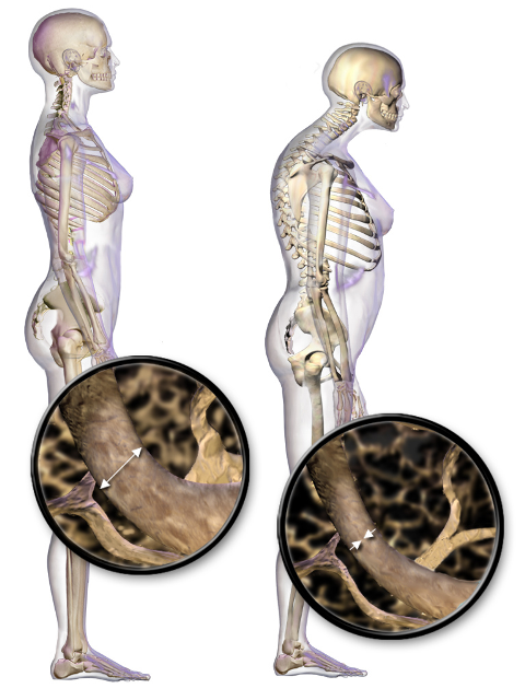 Osteoporozė