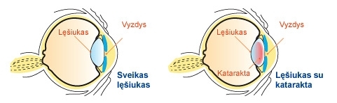 katarakta