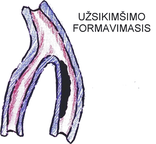 užsikimšimo