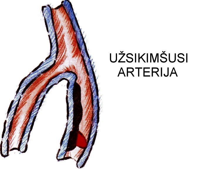 užsikišusi