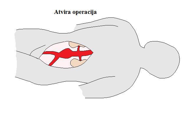 aorta