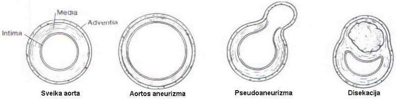 brezinys