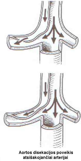 aortos aneurizma gydymas