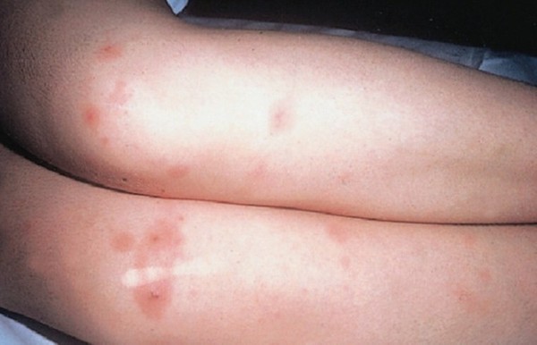 meningokokine_infekcija