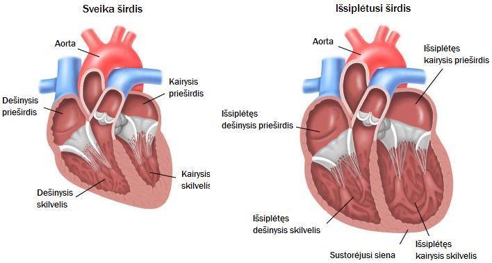 kardiomiopatija